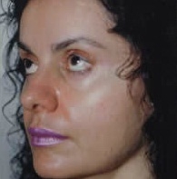 Rhinoplasty. BeforeTreatment Photos - female, left side - oblique view, patient 5