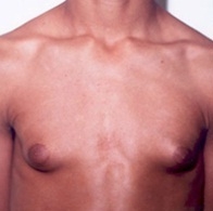 Gynecomastia. Before Treatment Photos - male, front view, patient 5