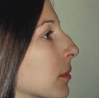 Rhinoplasty. Before Treatment Photos - female, right side view, patient 6