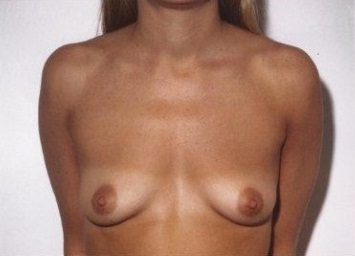 Breast Augmentation: Before Treatment Photos - female, front view, patient 6