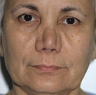 Facelift - Before Treatment Photos - female, front view, patient 7