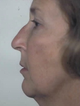 Rhinoplasty. Before Treatment Photos - female, left side view, patient 7