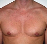 Gynecomastia. Before Treatment Photos - male, front view, patient 7
