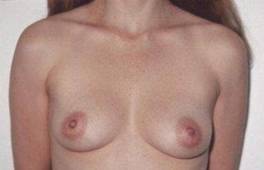 Breast Augmentation: Before Treatment Photos - female, front view, patient 7