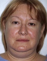 Facelift - Before Treatment Photos - female, front view, patient 8