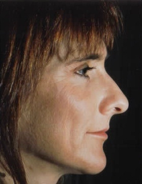 Rhinoplasty. Before Treatment Photos - female, right side view, patient 8