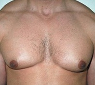Gynecomastia. Before Treatment Photos - male, front view, patient 8