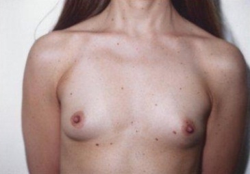 Breast Augmentation: Before Treatment Photos - female, front view, patient 8