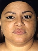 Facelift - Before Treatment Photos - female, front view, patient 9