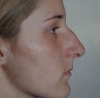Rhinoplasty. Before Treatment Photos - female, right side view, patient 9