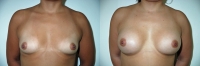 Breast Augmentation: Before and After Treatment Photos - female, front view, patient 10