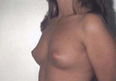 Breast Augmentation: Before Treatment Photos - female, left side oblique view, patient 11