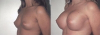 Breast Augmentation: Before and After Treatment Photos - female, left side oblique view, patient 11