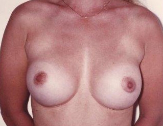 Breast Augmentation: After Treatment Photos - female, front view, patient 12
