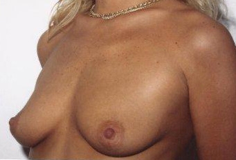 Breast Augmentation: Before Treatment Photos - female, left side oblique view, patient 13
