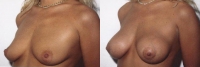 Breast Augmentation: Before and After Treatment Photos - female, left side oblique view, patient 13