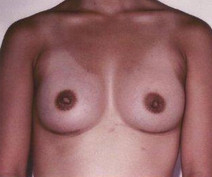 Breast Augmentation: After Treatment Photos - female, front view, patient 15
