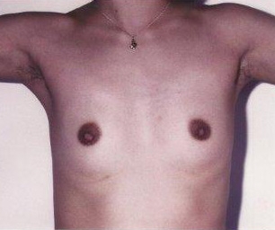 Breast Augmentation: Before Treatment Photos - female, front view, patient 15