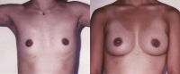 Breast Augmentation: Before and After Treatment Photos - female, front view, patient 15
