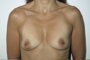 Breast Augmentation: Before Treatment Photos - female, front view, patient 9