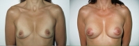 Breast Augmentation: Before and After Treatment Photos - female, front view, patient 9