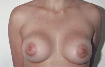 Breast Augmentation: After Treatment Photos - female, front view, patient 16