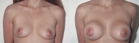 Breast Augmentation: Before and After Treatment Photos - female, front view, patient 16