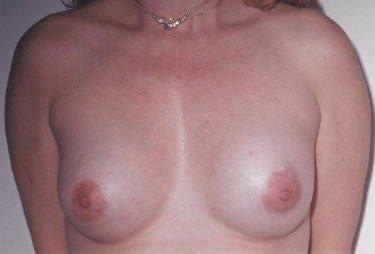 Breast Augmentation: After Treatment Photos - female, front view, patient 17