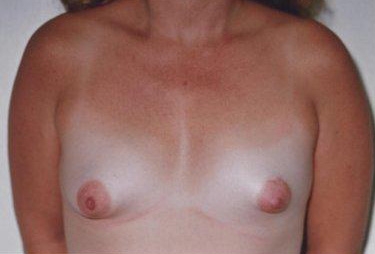 Breast Augmentation: Before Treatment Photos - female, front view, patient 17