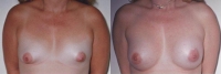 Breast Augmentation: Before and After Treatment Photos - female, front view, patient 17