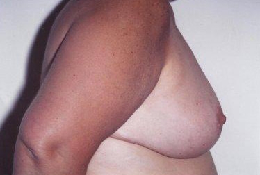 Breast Reduction: After Treatment Photos - female, left side view, patient 1