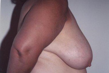 Breast Reduction: Before Treatment Photos - female, left side view, patient 1