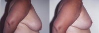 Breast Reduction: Before and After Treatment Photos - female, left side view, patient 1
