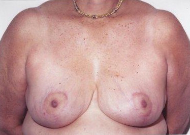 Breast Reduction: After Treatment Photos - female, front view, patient 2