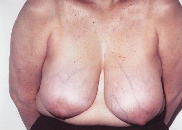 Breast Reduction: Before Treatment Photos - female, front view, patient 2