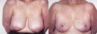 Breast Reduction: Before and After Treatment Photos - female, front view, patient 2