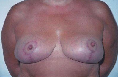 Breast Reduction: After Treatment Photos - female, front view, patient 3