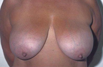 Breast Reduction: Before Treatment Photos - female, front view, patient 3