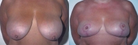 Breast Reduction: Before and After Treatment Photos - female, front view, patient 3