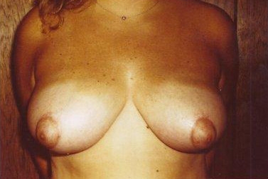 Breast Reduction: After Treatment Photos - female, front view, patient 4
