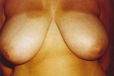 Breast Reduction: Before Treatment Photos - female, front view, patient 4