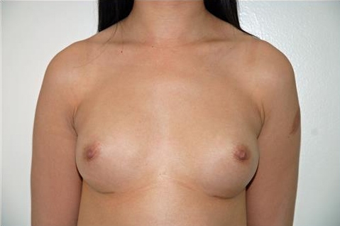 Breast Augmentation: After Treatment Photos - female, front view, patient 19