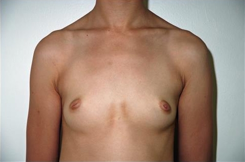 Breast Augmentation: Before Treatment Photos - female, front view, patient 19