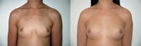 Breast Augmentation: Before and After Treatment Photos - female, front view, patient 19
