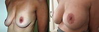 Breast Lift: Before and After Treatment Photos - female, left side oblique view, patient 2