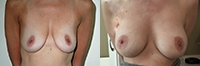 Breast Lift: Before and After Treatment Photos - female, front view, patient 2