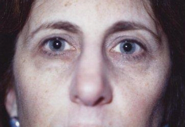 Mid Facelift - Before Treatment Photos - female, front view, patient 6
