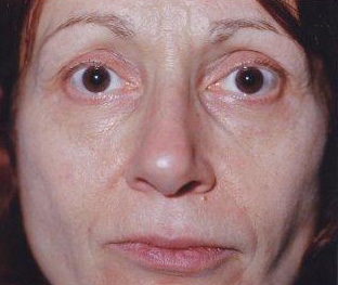 Mid Facelift - Before Treatment Photos - female, front view, patient 7