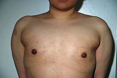 Female to Male Top Surgery. After Treatment Photos - male, front view, patient 1