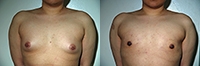Female to Male Top Surgery. Before and After Treatment Photos - male, front view, patient 5